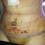 Liposuction Recovery - Bruising