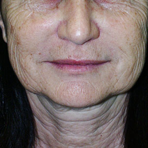 Laser Resurfacing Before & After Patient #3942
