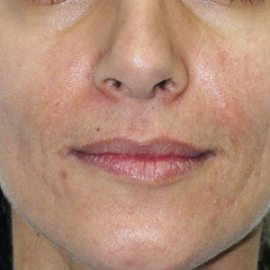 Laser Resurfacing Before & After Patient #3947